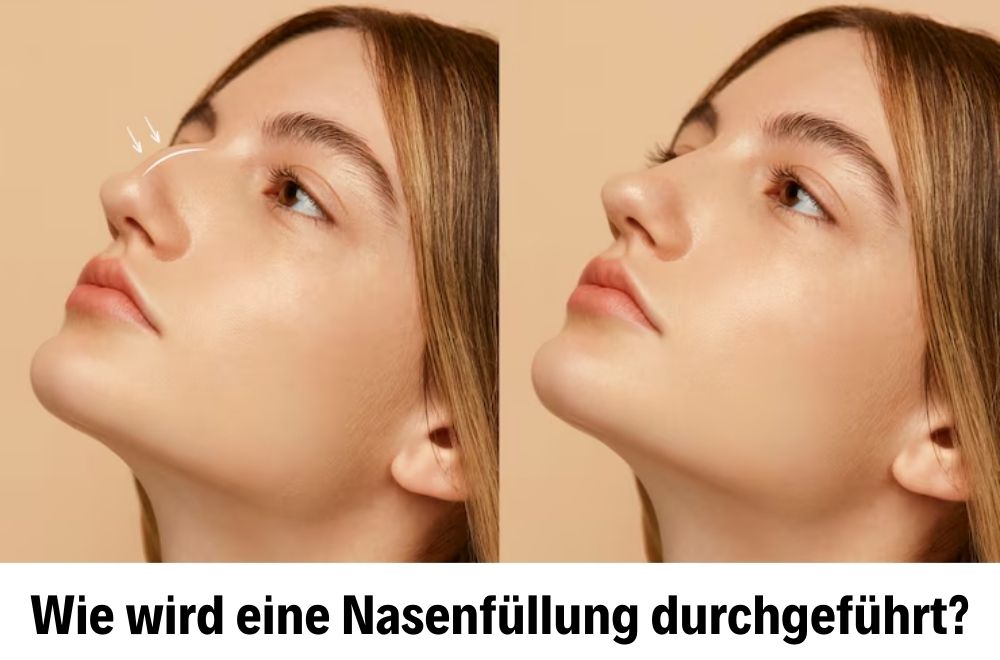 Nose Filler Nose Filler
