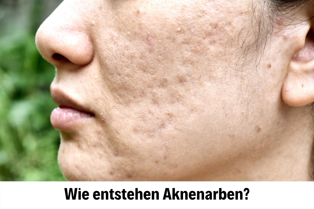 Acne Scars Acne Scars