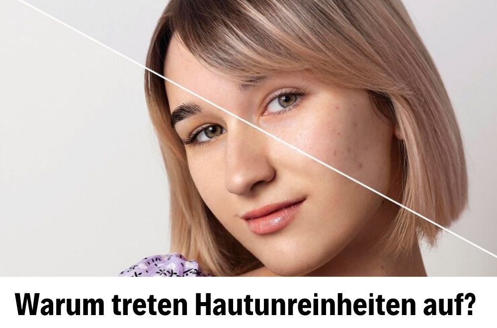 Behandlung von Hautunreinheiten Behandlung von Hautunreinheiten