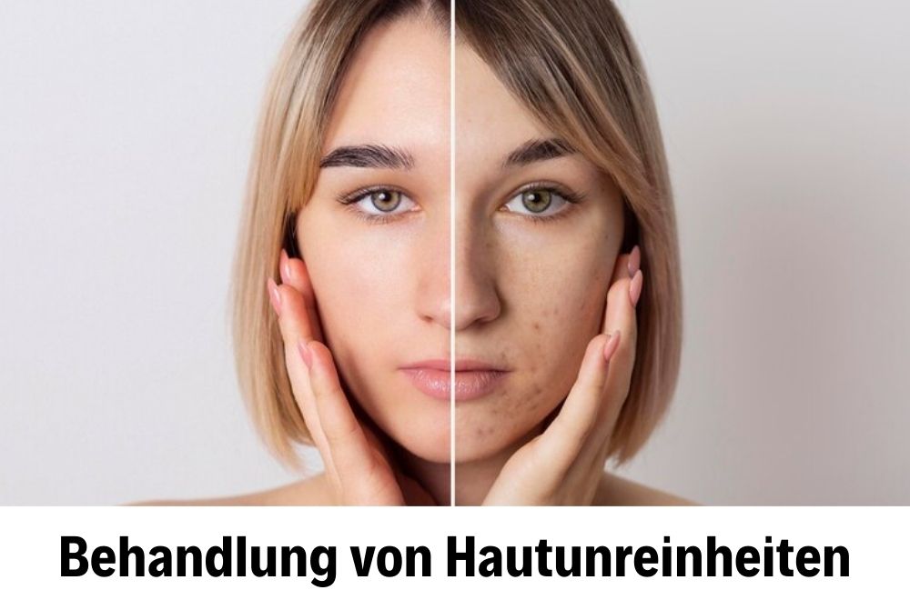 Behandlung von Hautunreinheiten Behandlung von Hautunreinheiten